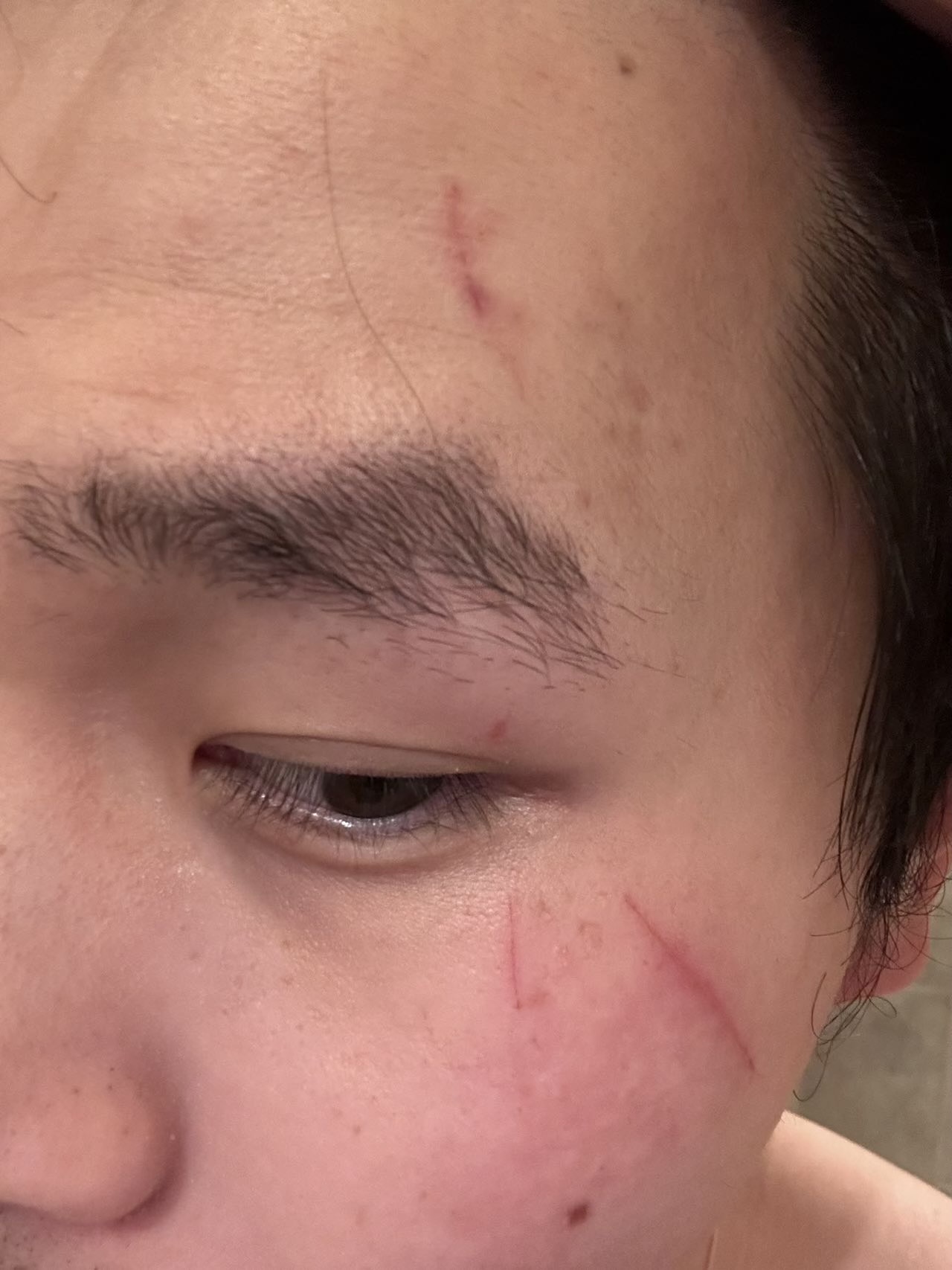 Close-up of a person's face showing a closed eye, eyebrow, and forehead with visible scratches.