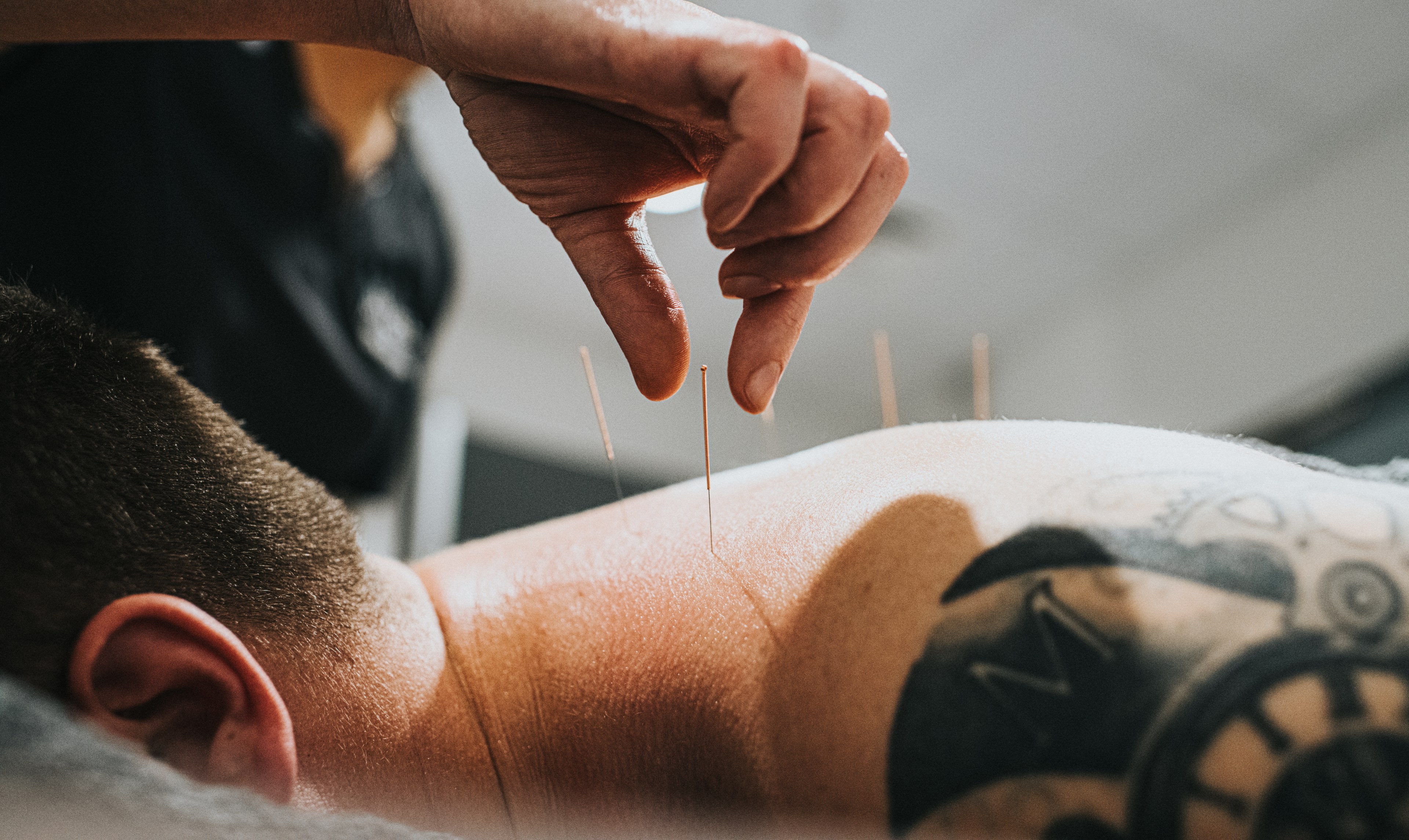 A person is lying face down, receiving acupuncture on their back. A hand is carefully inserting several thin needles into the skin.