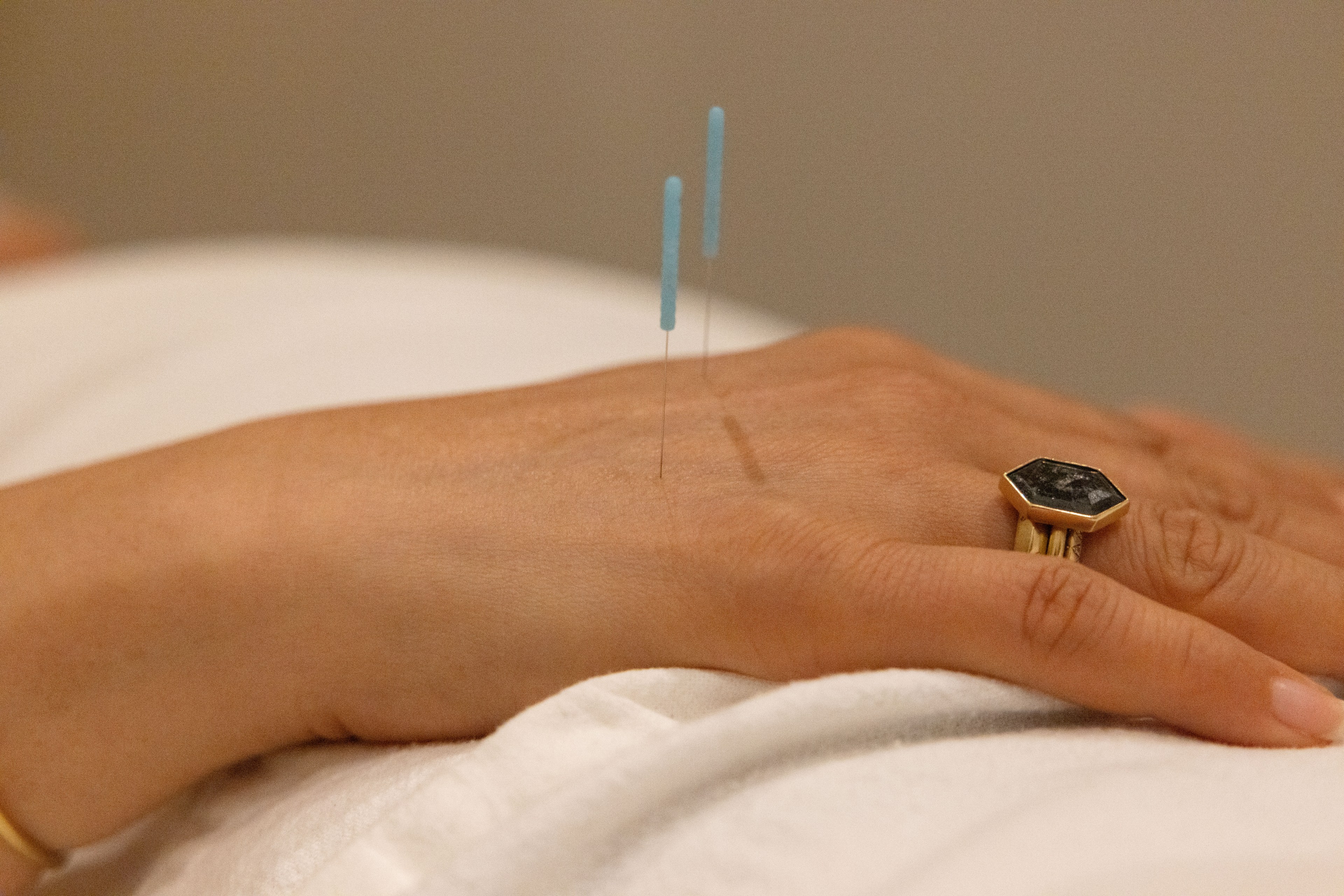 A hand rests on a white surface with two acupuncture needles inserted. The person is wearing a ring with a large, hexagonal gemstone.