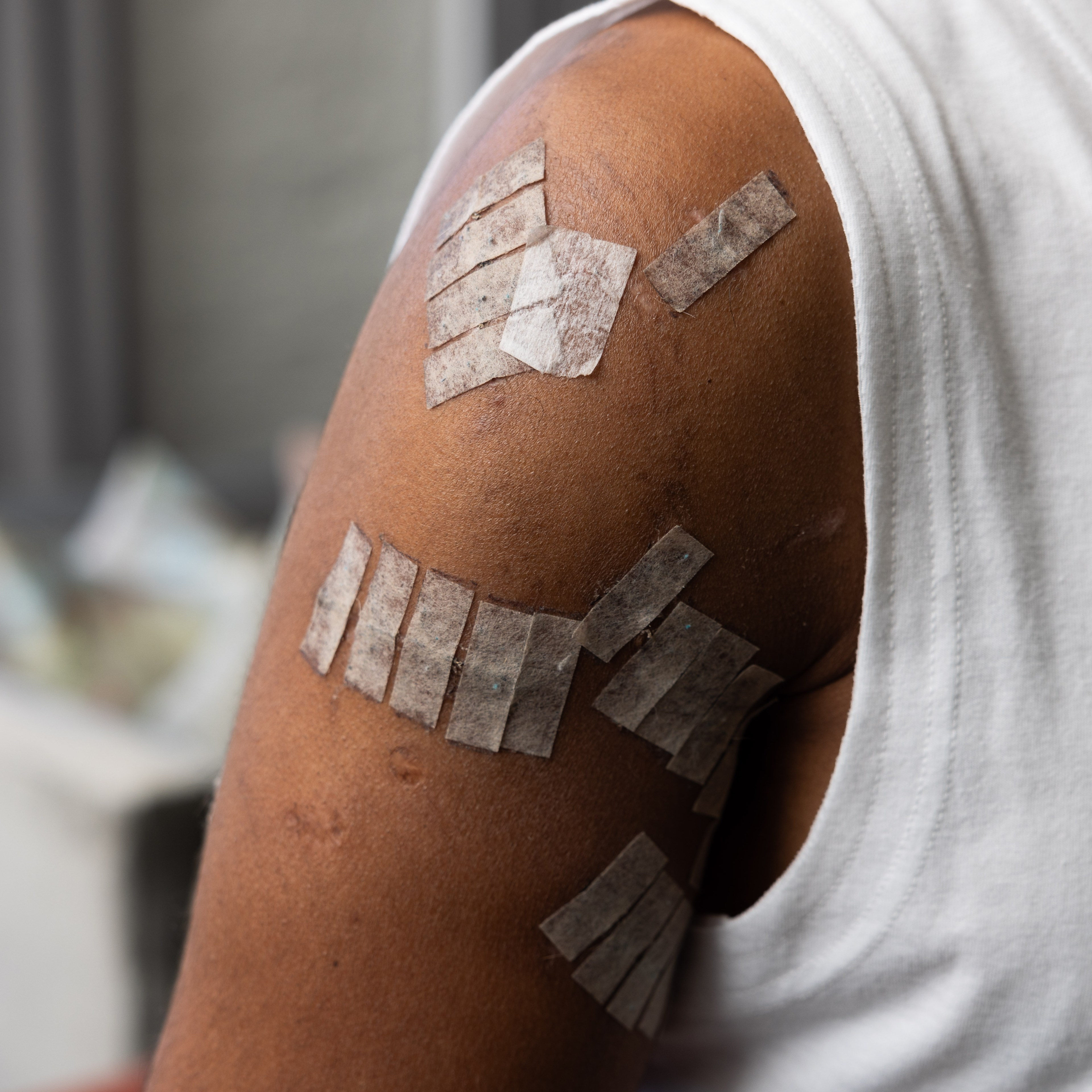 A person's arm with multiple small bandages in varying orientations covers the upper arm, which is clad in a sleeveless white shirt.