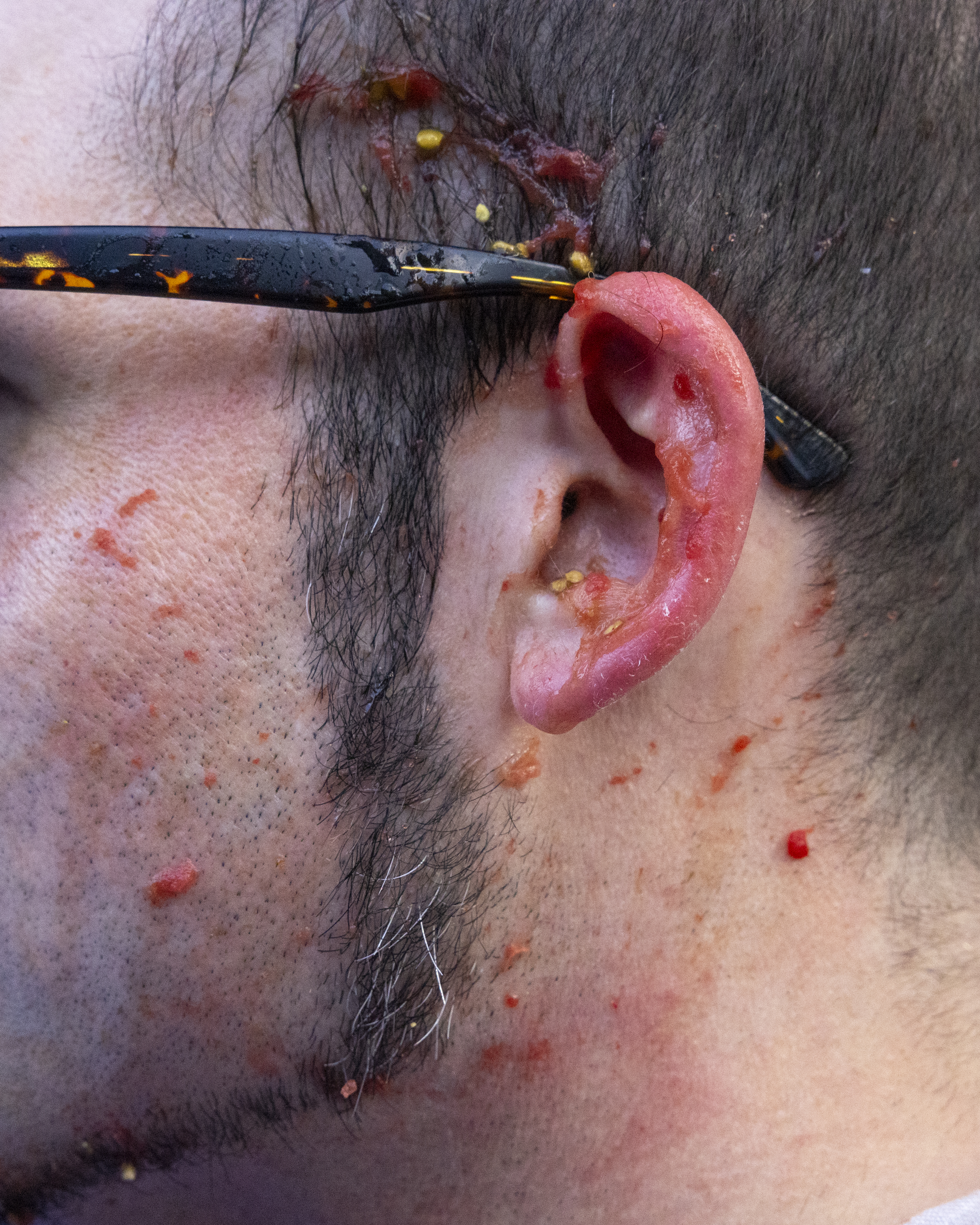 This image shows the side of a man's face with glasses, and his ear is covered with remnants of a messy substance, possibly food.