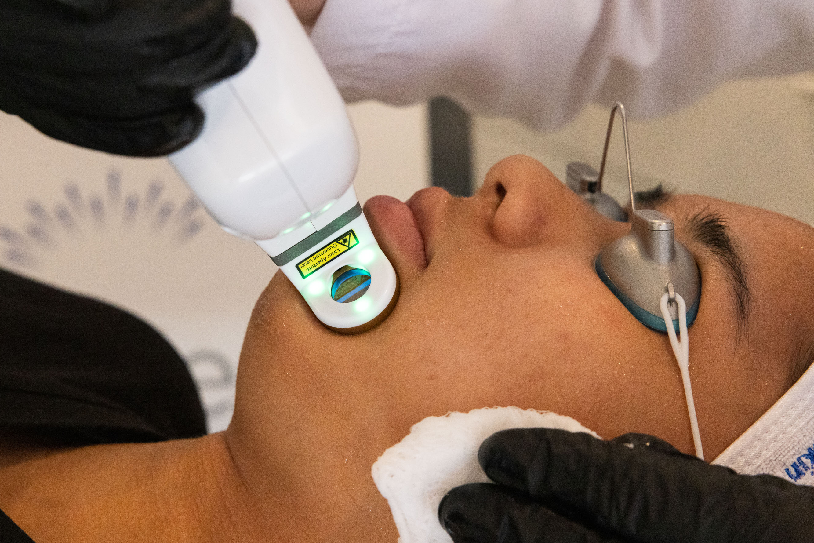 A person is receiving a facial treatment with a handheld laser device on their chin while wearing protective eye gear and a white headband, with a gloved hand holding a cloth to their face.