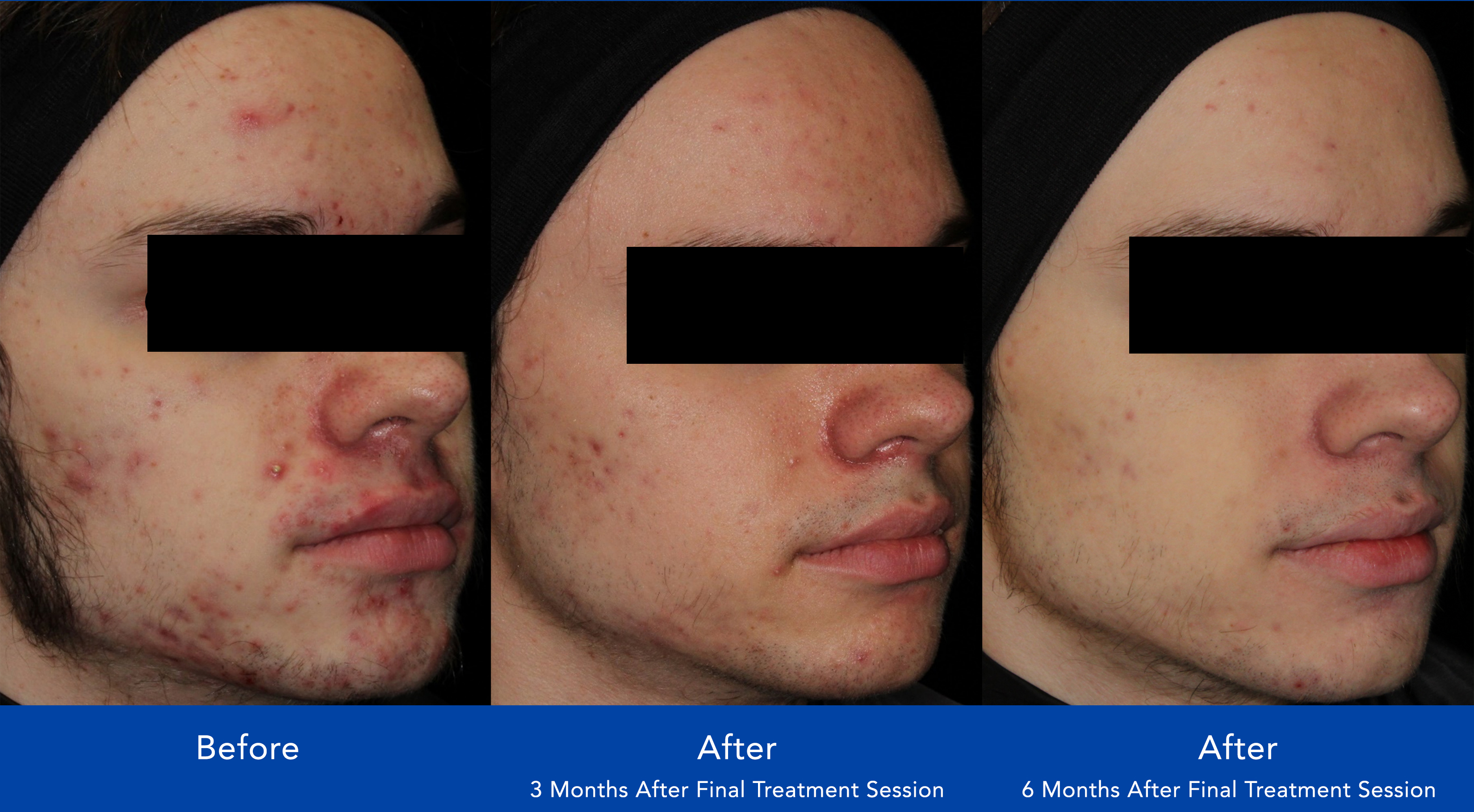 The image shows before and after photos of acne treatment. The left picture has significant acne, the middle shows improvement after 3 months, and the right shows further clarity after 6 months.