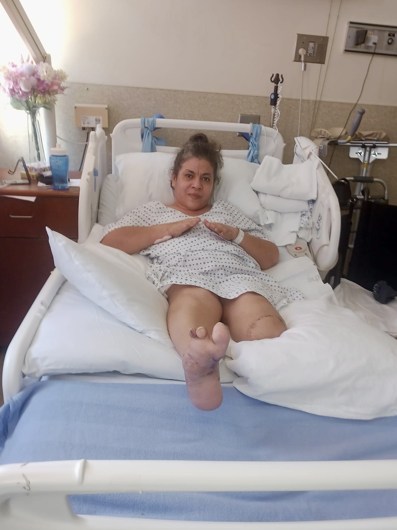 A woman in a hospital bed wearing a gown has her right leg bandaged and elevated on pillows. She appears to be resting, with folded hands on her chest.