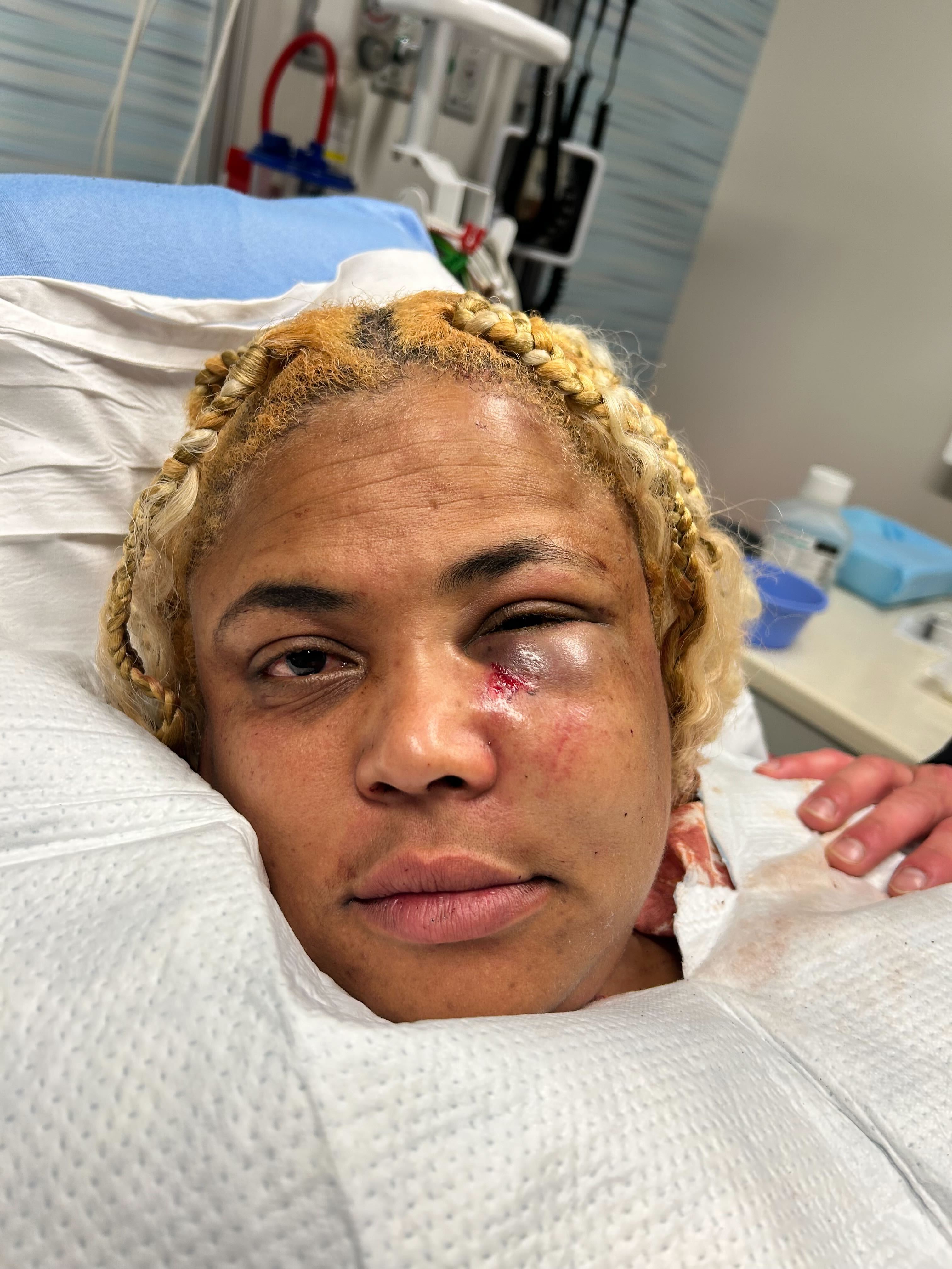 A person with braided blonde hair is lying down wearing a medical gown. They have a swollen and bruised left eye, with a small cut and some redness on their cheek.