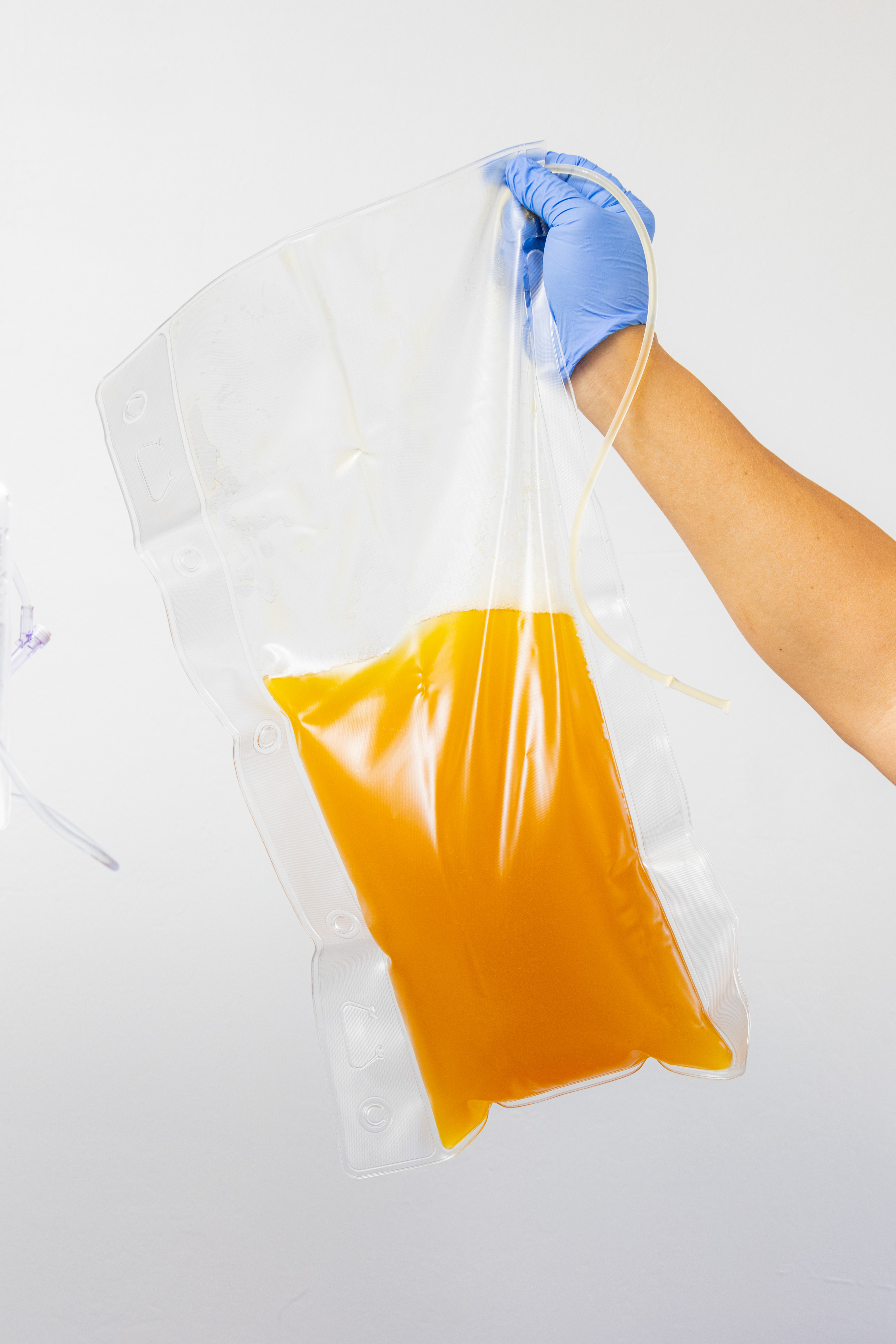 A gloved hand holds up a clear plastic bag filled with bright orange liquid, possibly medical plasma, with a tube attached.