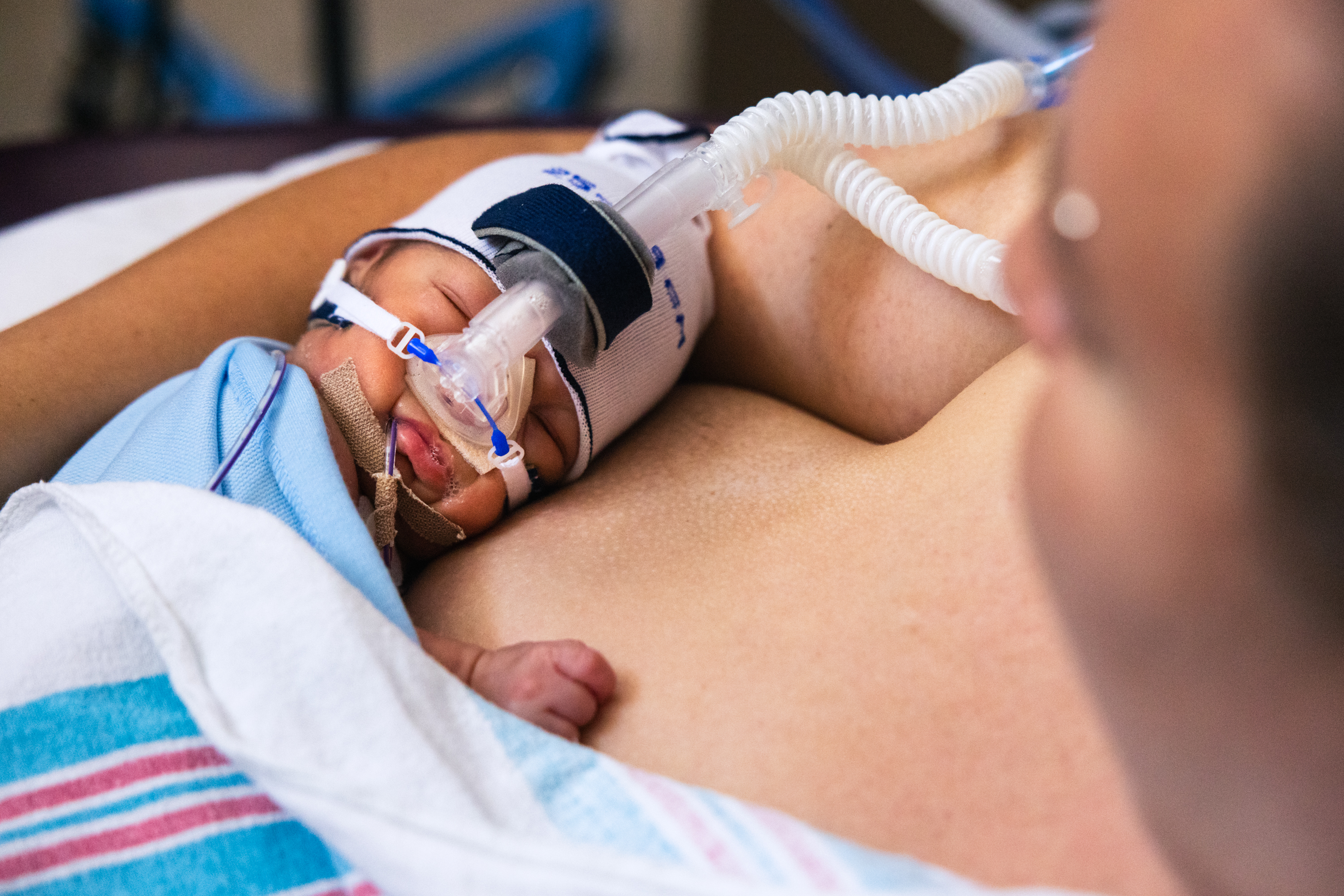 A newborn baby, wearing a breathing mask, rests on a person's chest, wrapped in a blue blanket with a striped hospital cloth underneath.