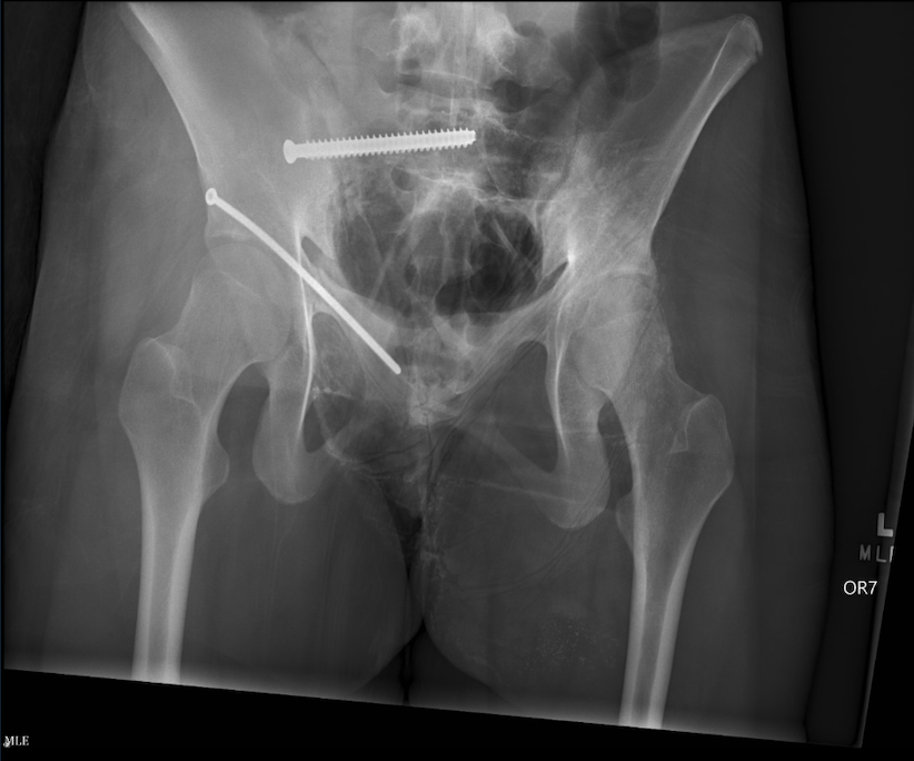 This X-ray shows a pelvic region with two surgical screws in the left side, likely indicating a bone fixation procedure.