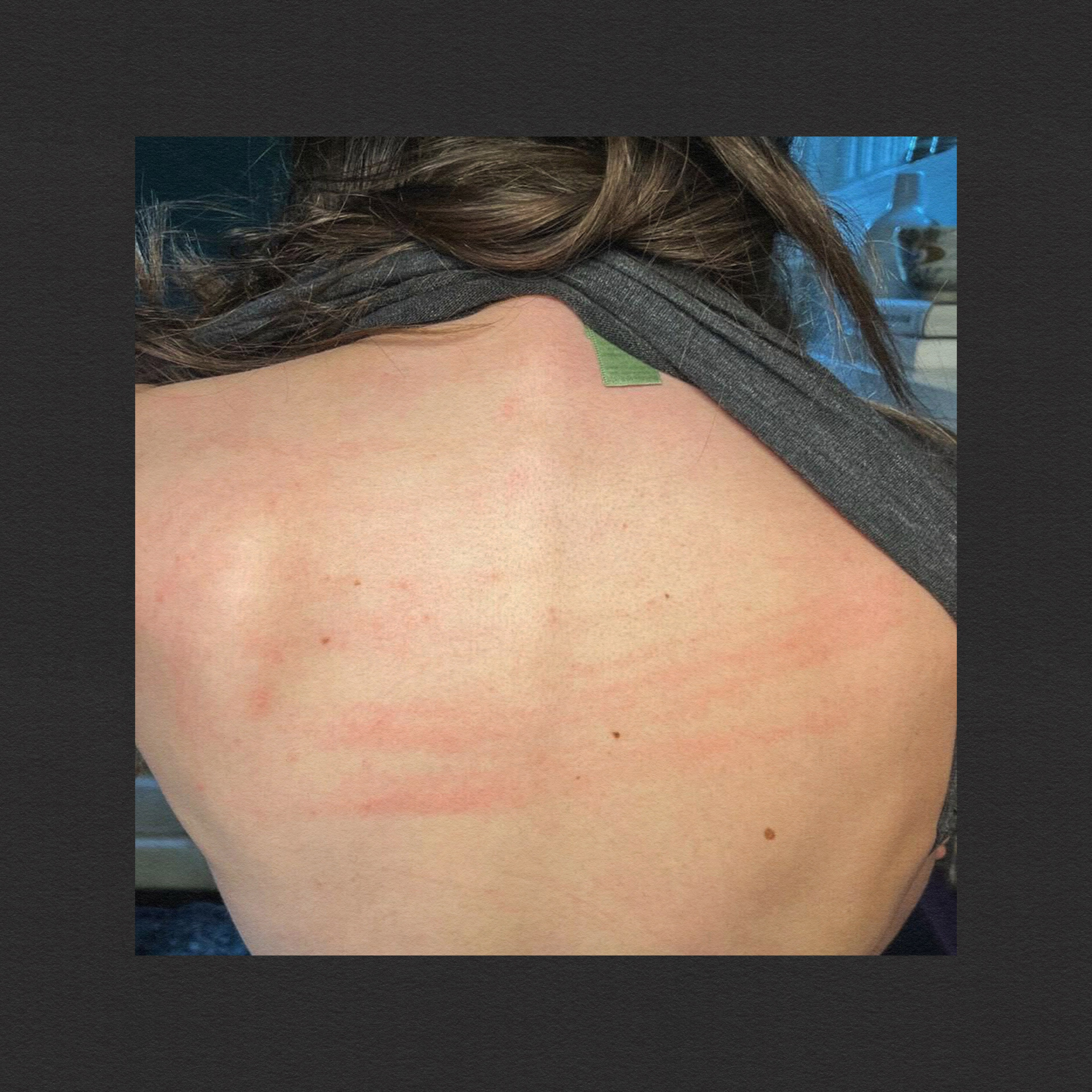 A person's back displays several red, horizontal marks. Their hair is pulled to the side, and they're lifting a dark shirt to reveal the skin.