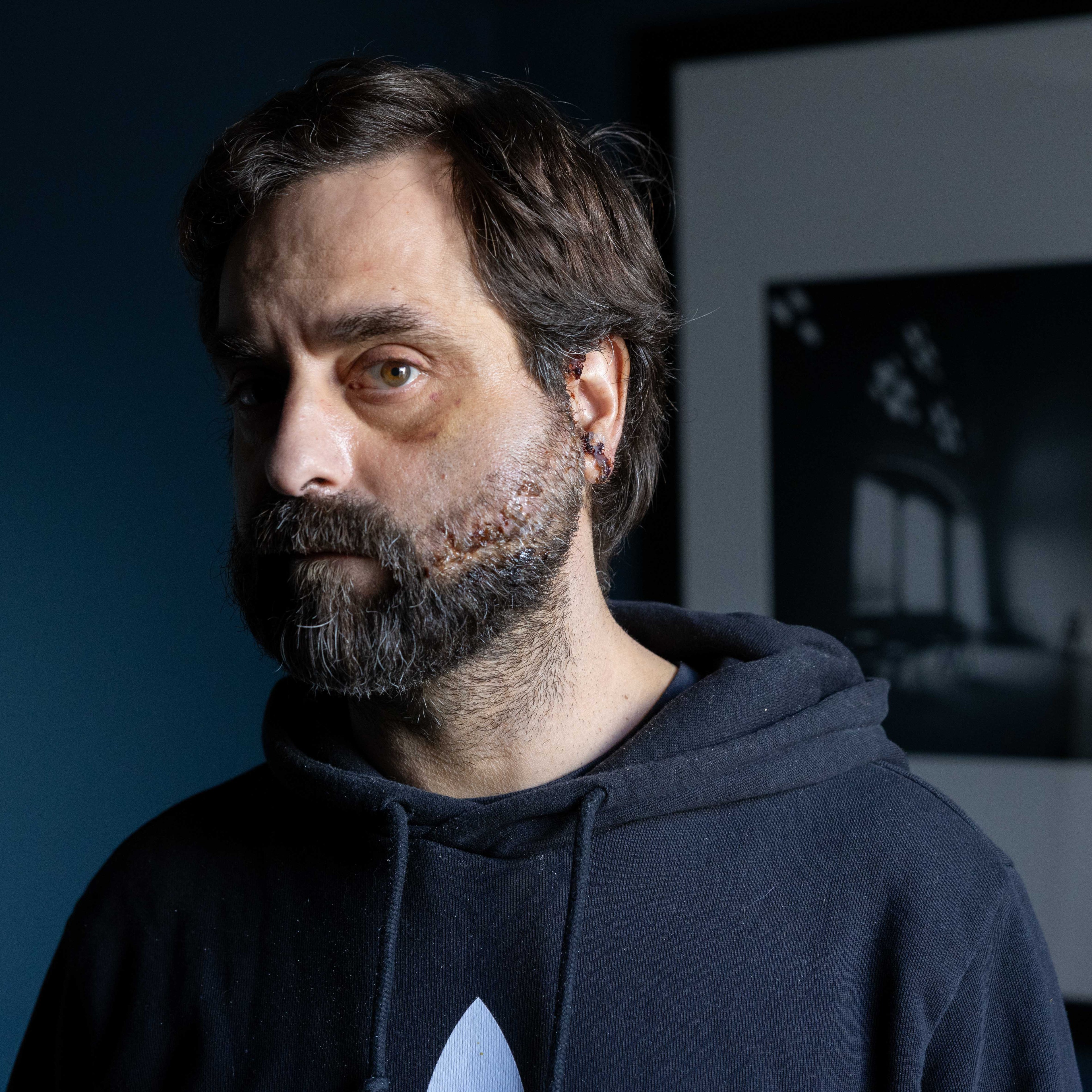 A man with a beard and a bruised eye stands in front of a dark blue wall, wearing a black hoodie. A framed black and white photo hangs on the wall.