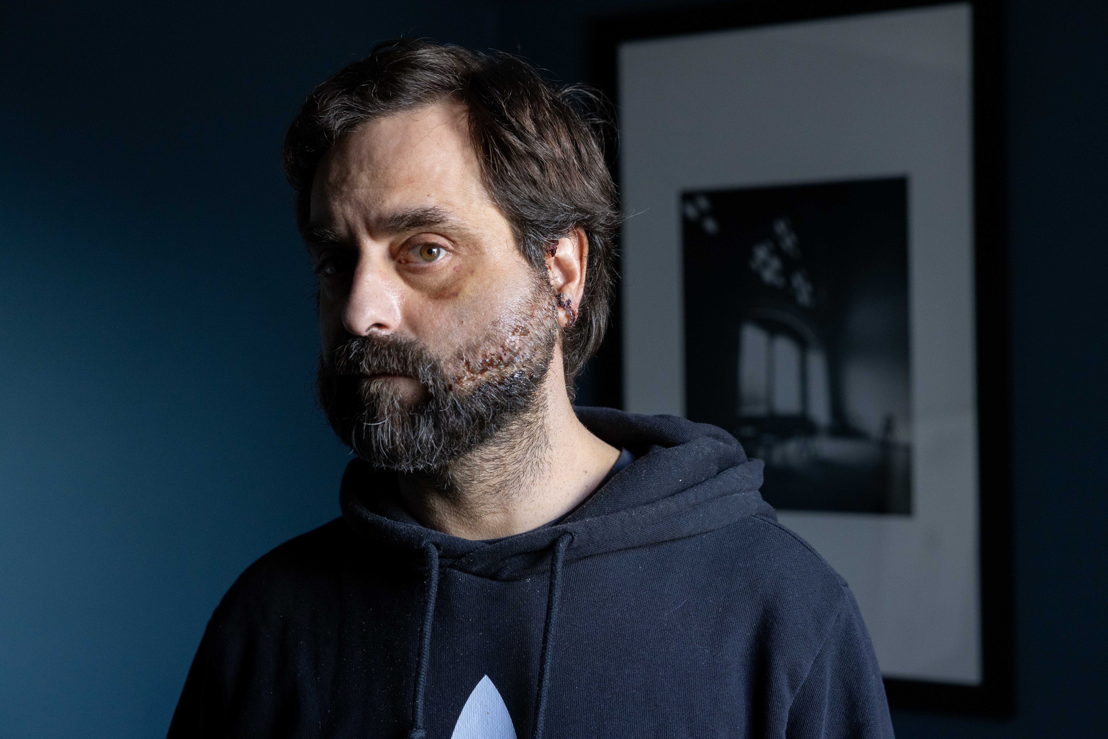 A man with a beard and a bruised eye stands in front of a dark blue wall, wearing a black hoodie. A framed black and white photo hangs on the wall.